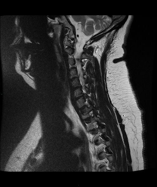 File:Cervical disc prolapse (Radiopaedia 80258-93598 Sagittal T2 11).jpg