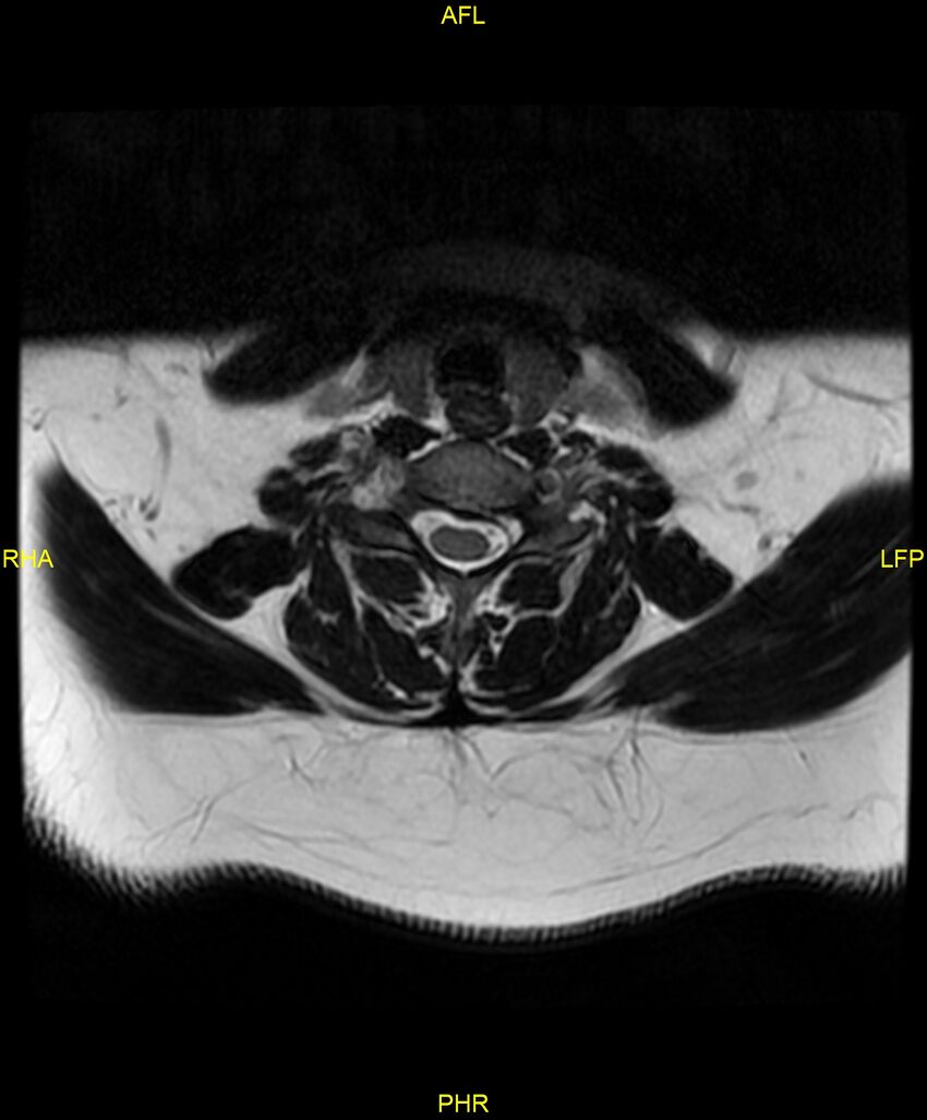 Cervical disc protrusion (Radiopaedia 87147-103415 Axial T2 44).jpg