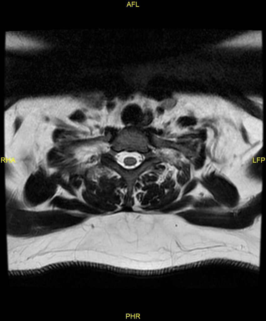 Cervical disc protrusion (Radiopaedia 87147-103415 Axial T2 75).jpg