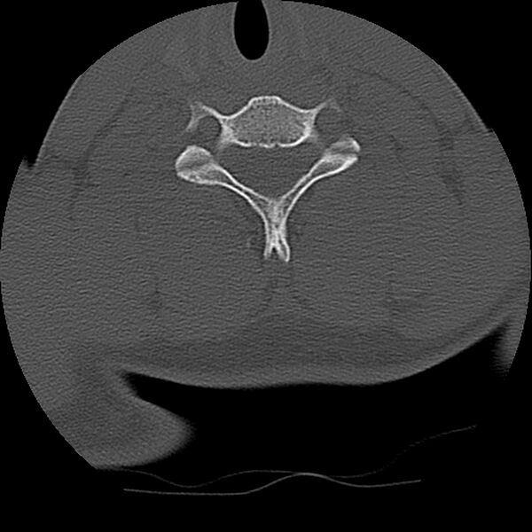 File:Cervical flexion teardrop fracture with cord hemorrhage (Radiopaedia 32497-33454 Axial bone window 60).jpg