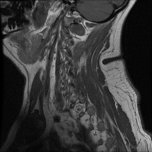 File:Cervical fracture and dislocation with locked facet (Radiopaedia 31837-32781 Sagittal T1 16).jpg