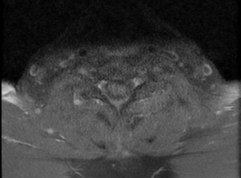 File:Cervical schwannoma (Radiopaedia 72399-82934 Axial T1 C+ fat sat 17).jpg