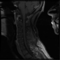 Cervical vertebrae metastasis (Radiopaedia 78814-91667 G 7).png