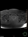Cesarian scar endometriosis (Radiopaedia 68495-78066 Axial T1 fat sat 21).jpg