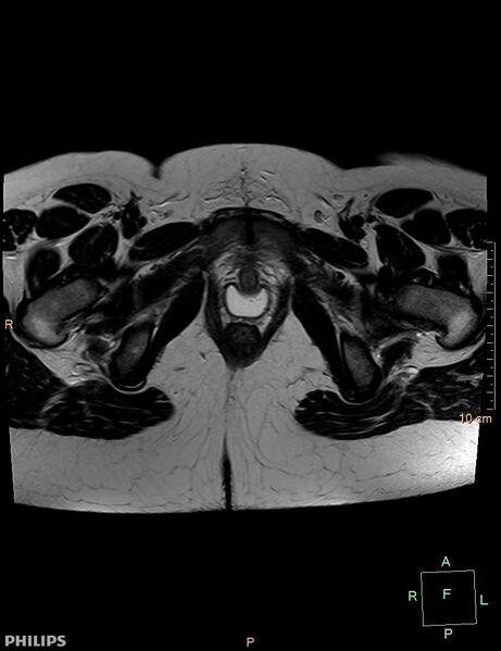 File:Cesarian scar endometriosis (Radiopaedia 68495-78066 Axial T2 23).jpg