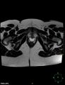 Cesarian scar endometriosis (Radiopaedia 68495-78066 Axial T2 23).jpg