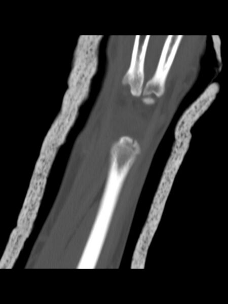 File:Chauffeur's (Hutchinson) fracture (Radiopaedia 58043-65079 Coronal bone window 12).jpg