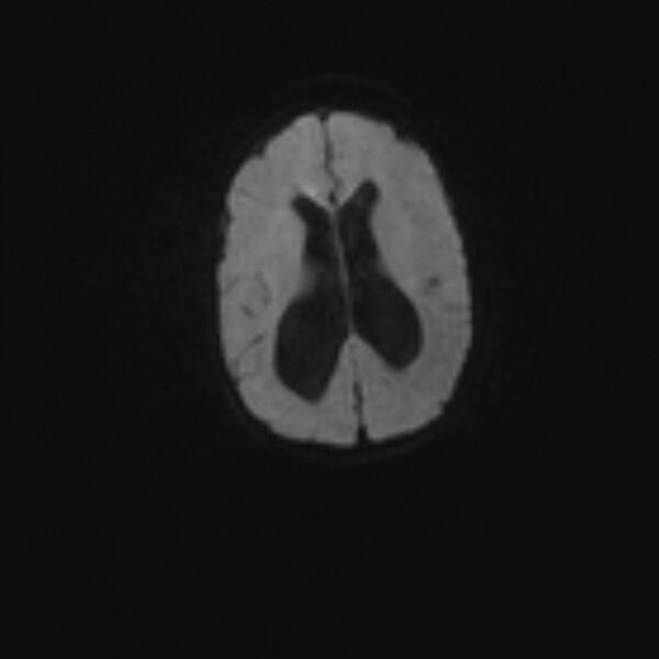File:Chiari III malformation with occipital encephalocele (Radiopaedia 79446-92559 Axial DWI 34).jpg
