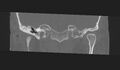 Cholesteatoma (Radiopaedia 10742-11203 Coronal bone window 3).jpg