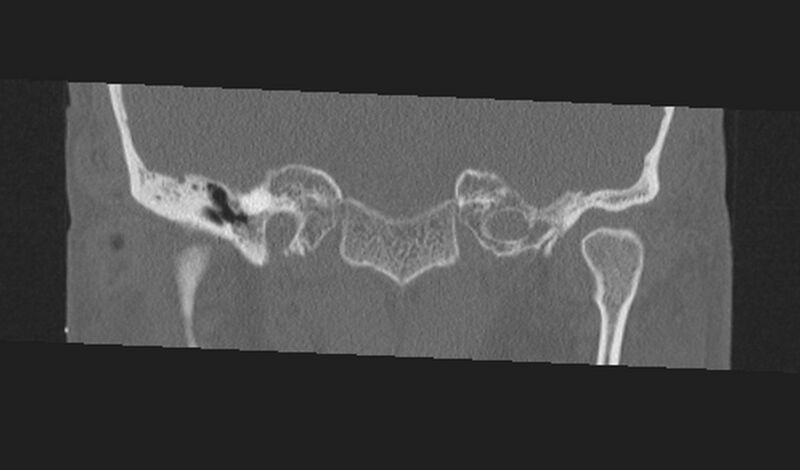 File:Cholesteatoma (Radiopaedia 10742-11203 Coronal bone window 3).jpg