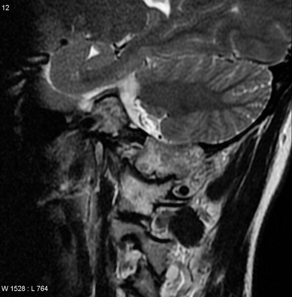 File:Chondroblastoma - occipital condyle (Radiopaedia 5569-7306 Sagittal T2 1).jpg