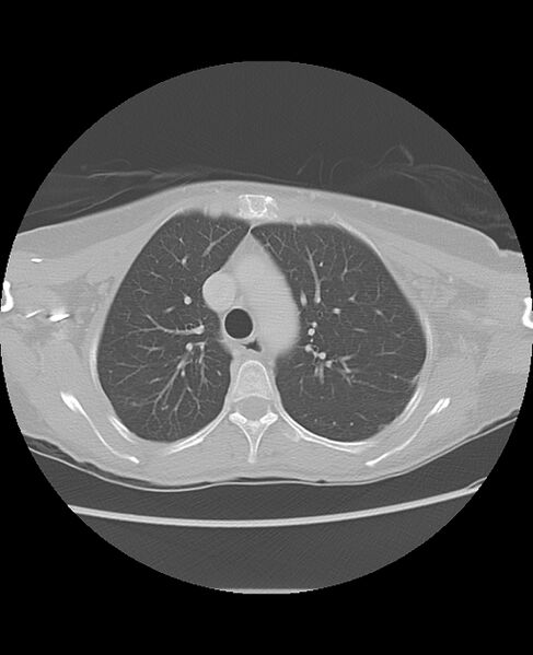 File:Chondrosarcoma (Radiopaedia 79427-92532 Axial lung window 17).jpg