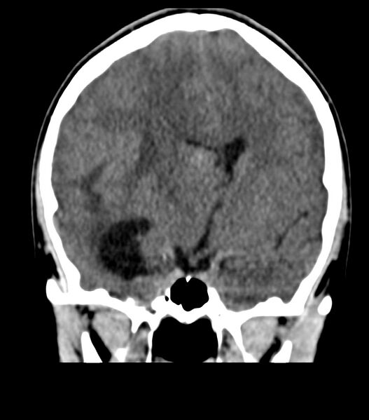 File:Choroid plexus carcinoma (Radiopaedia 91013-108552 Coronal non-contrast 37).jpg