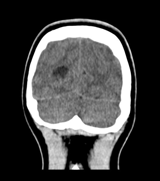 File:Choroid plexus carcinoma (Radiopaedia 91013-108552 Coronal non-contrast 75).jpg