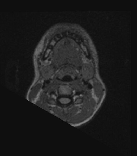 File:Choroid plexus carcinoma (Radiopaedia 91013-108553 Axial FLAIR C+ 21).jpg