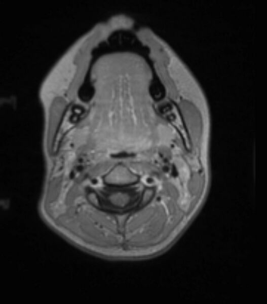File:Choroid plexus carcinoma (Radiopaedia 91013-108553 Axial T1 C+ 40).jpg