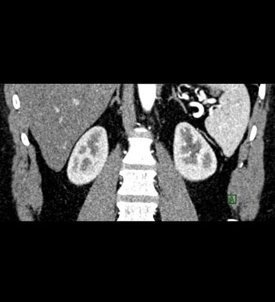 File:Chromophobe renal cell carcinoma (Radiopaedia 84286-99573 E 60).jpg