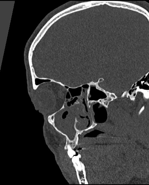 File:Chronic maxillary sinusitis caused by a foreign body (Radiopaedia 58521-65676 Sagittal bone window 12).jpg