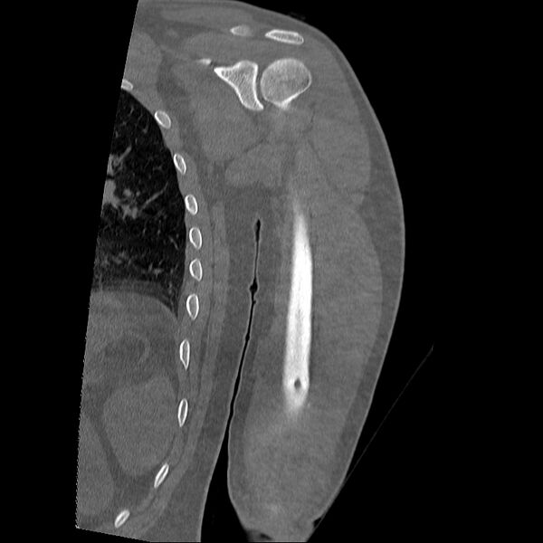File:Chronic osteomyelitis (Radiopaedia 67597-76998 Coronal bone window 14).jpg
