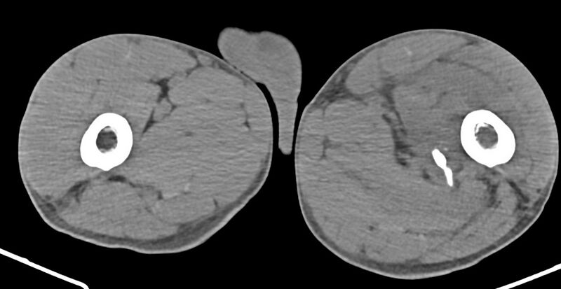 File:Chronic osteomyelitis (with sequestrum) (Radiopaedia 74813-85822 D 73).jpg