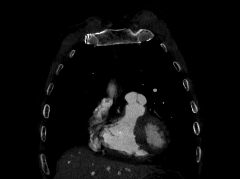File:Chronic pulmonary embolism (Radiopaedia 91241-108843 A 16).jpg