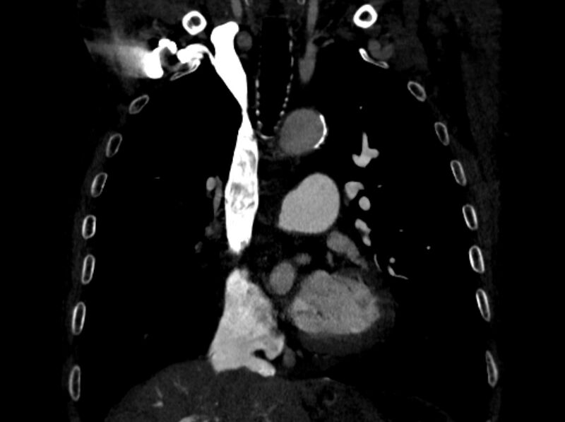 File:Chronic pulmonary embolism (Radiopaedia 91241-108843 A 45).jpg