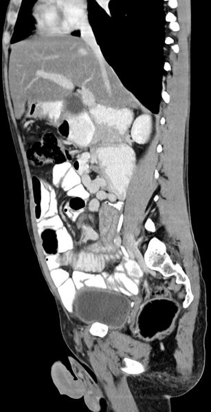 File:Chronic small bowel volvulus (Radiopaedia 75224-86322 C 89).jpg
