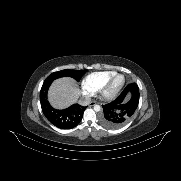 File:Chronic thromboembolic pulmonary hypertension (CTEPH) (Radiopaedia 74597-85532 Axial C+ CTPA 47).jpg