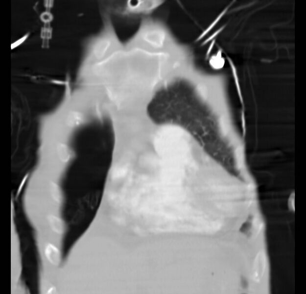 File:Clagett thoracotomy with bronchopleural fistula (Radiopaedia 29192-29587 Coronal lung window 26).jpg