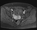 Class II Mullerian duct anomaly- unicornuate uterus with rudimentary horn and non-communicating cavity (Radiopaedia 39441-41755 Axial T1 fat sat 75).jpg