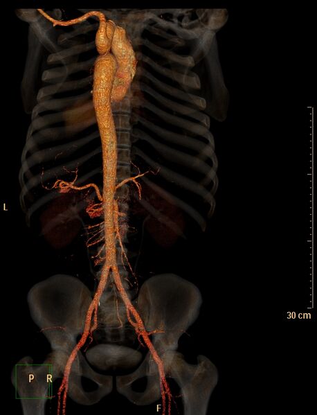 File:Coarctation of the aorta (Radiopaedia 49784-55050 3D VRT 12).jpg