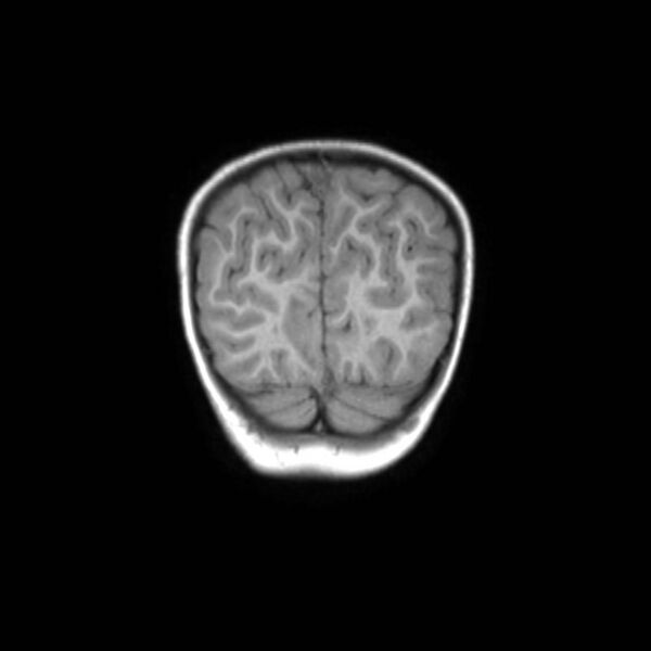 File:Cochlear nerve aplasia - unilateral (Radiopaedia 87910-104413 Coronal T1 47).jpg