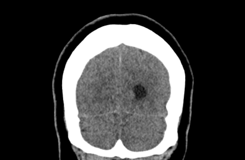 Colloid cyst (Radiopaedia 53180-59146 Coronal non-contrast 75).jpg