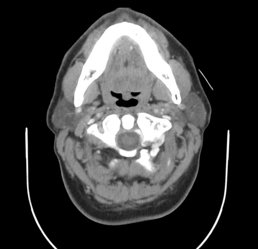 Colloid cyst of thyroid (Radiopaedia 22897-22923 Axial C+ delayed 24).jpg