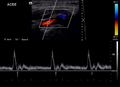 External carotid artery - normal Doppler waveform (Radiopaedia 20309).png