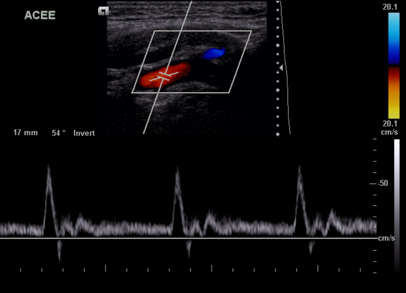 File:External carotid artery - normal Doppler waveform (Radiopaedia 20309).png