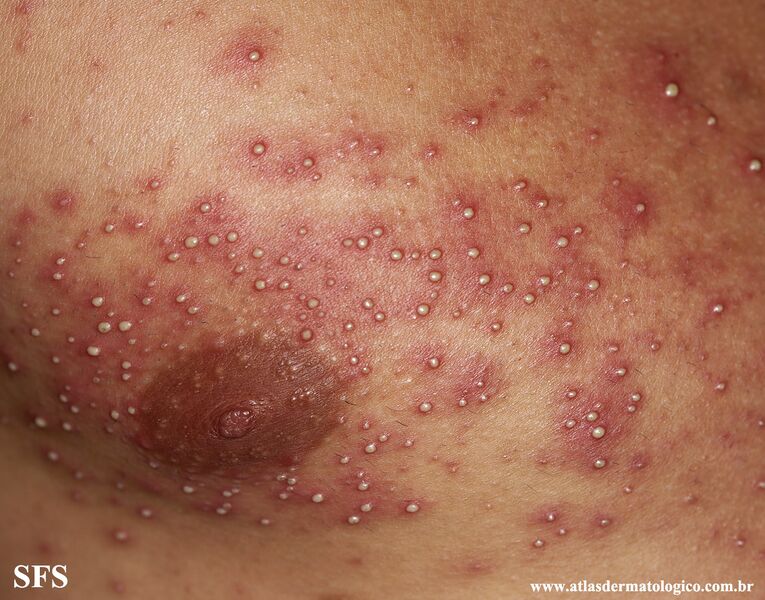 File:Folliculitis (Dermatology Atlas 22).jpg