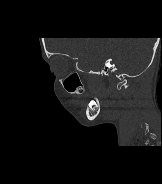 File:Nasoorbitoethmoid fracture (Radiopaedia 90044-107205 Sagittal bone window 47).jpg