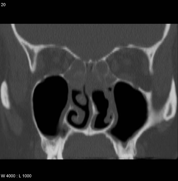 File:Nasopharyngeal carcinoma (recurrent) (Radiopaedia 5061-6903 Coronal bone window 2).jpg