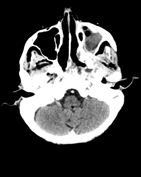File:Nasopharyngeal carcinoma with cerebral abscess (Radiopaedia 43018-46275 Axial C+ delayed 11).png