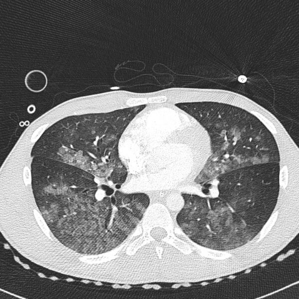 File:Near drowning (pulmonary edema) (Radiopaedia 24685-24958 lung window 37).jpg
