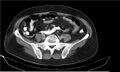Necrotizing pancreatitis (Radiopaedia 20595-20495 Axial C+ delayed 32).jpg