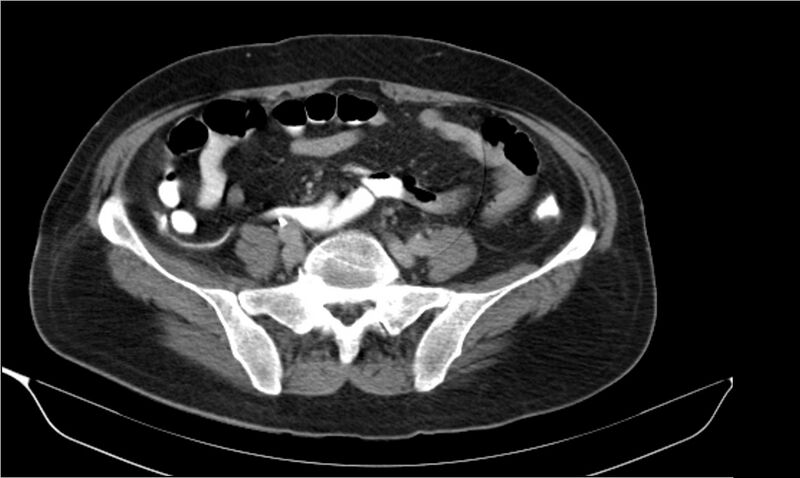 File:Necrotizing pancreatitis (Radiopaedia 20595-20495 Axial C+ delayed 32).jpg