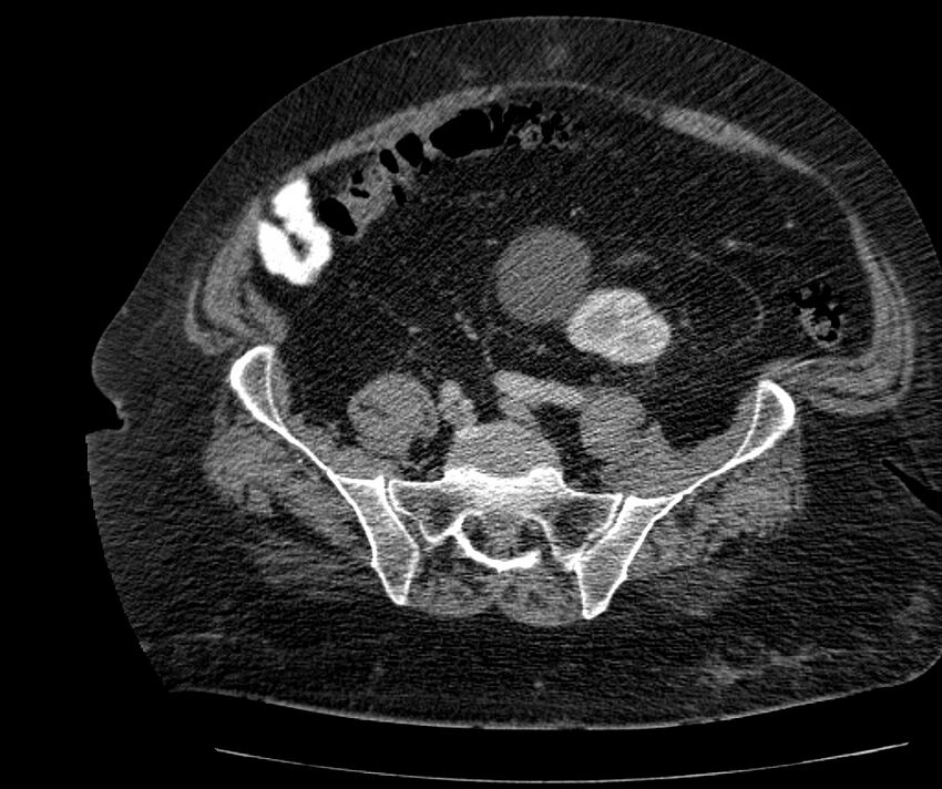 Nephroptosis with inguinal hernia containing perirenal fat (Radiopaedia 56632-63391 C 251).jpg