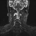 Neurofibromatosis type 1 (Radiopaedia 80355-93740 Coronal STIR 6).jpg