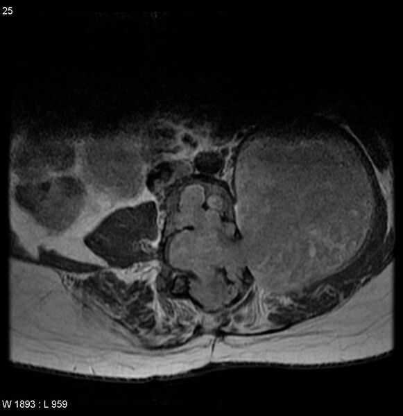 File:Neurofibromatosis type 2 - cranial and spinal involvement (Radiopaedia 5351-7112 Axial T1 C+ 25).jpg