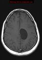 Neuroglial cyst (Radiopaedia 10713-11184 Axial T1 7).jpg
