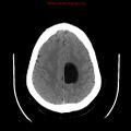 Neuroglial cyst (Radiopaedia 10713-11185 Axial non-contrast 9).jpg