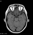 Neurosarcoidosis (Radiopaedia 10930-11351 Axial T1 7).jpg