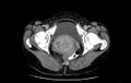 Non-puerperal uterine inversion (Radiopaedia 78343-91094 A 69).jpg